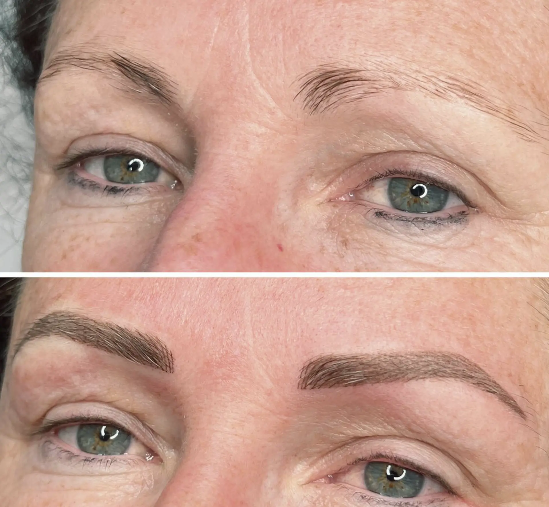 Microblading removal